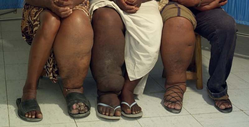 Lymphatic Filariasis Remains Endemic in 31 African Countries